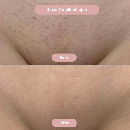 Pureshave - Glöm irriterande röda prickar!