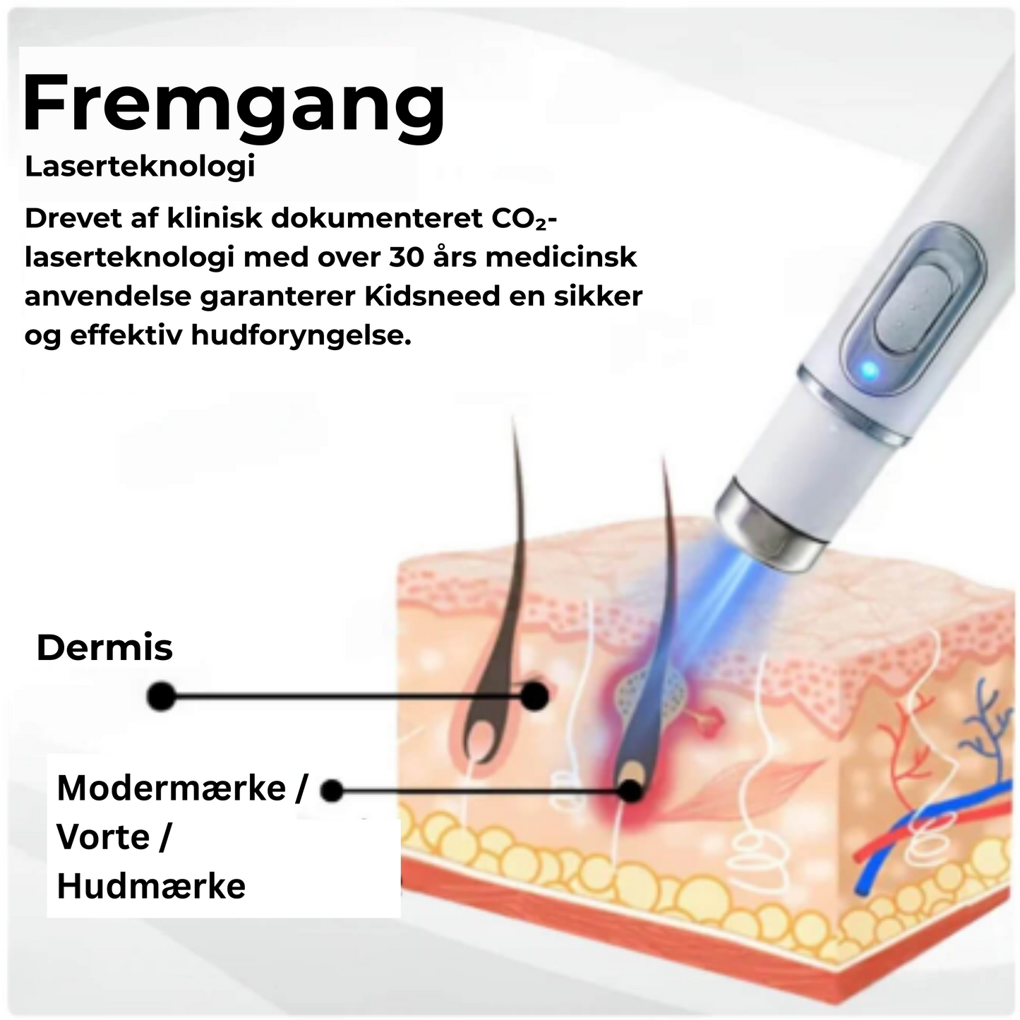 Kidsneed – Ikke-invasiv laserpen til fjernelse af modermærker og vorter