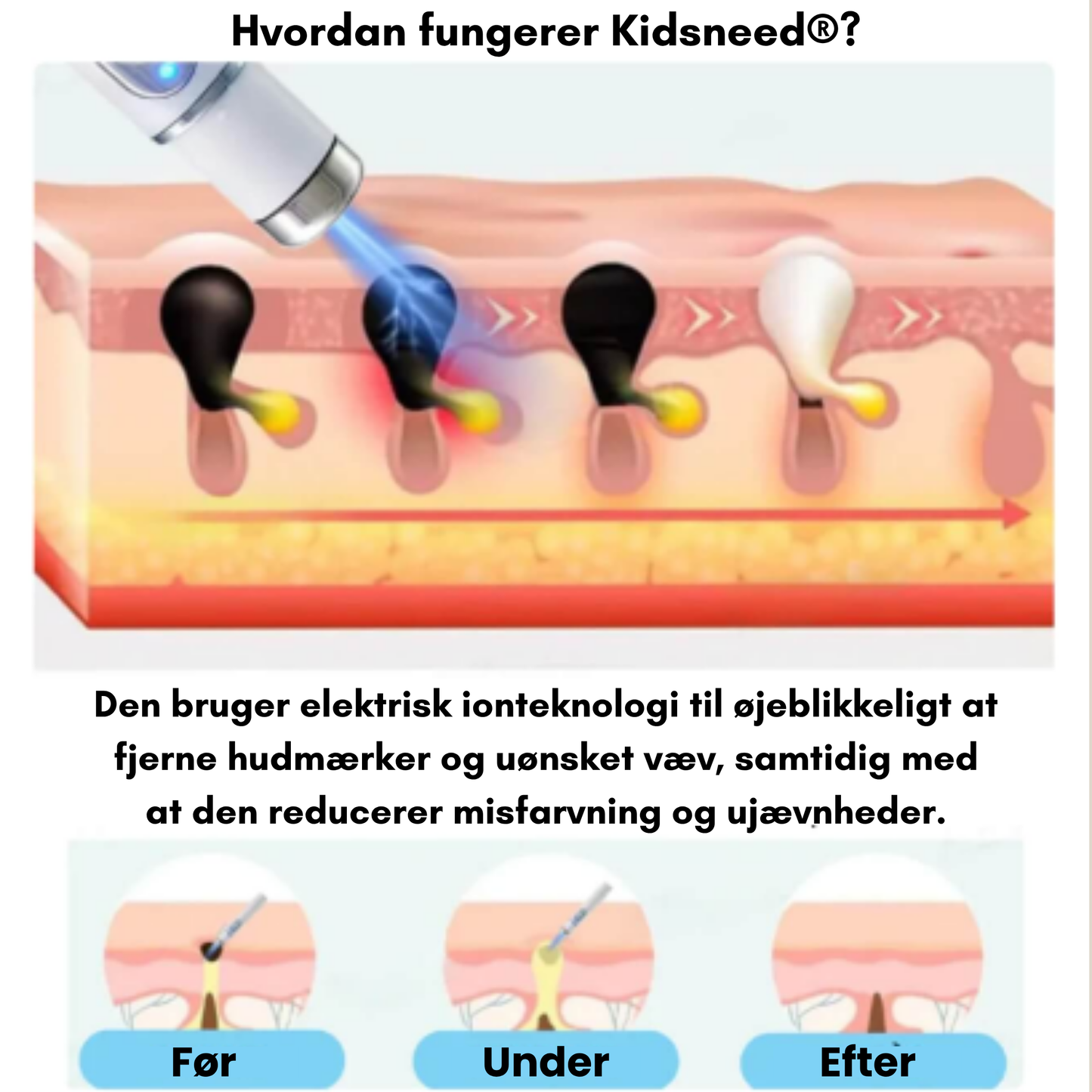 Kidsneed – Ikke-invasiv laserpen til fjernelse af modermærker og vorter